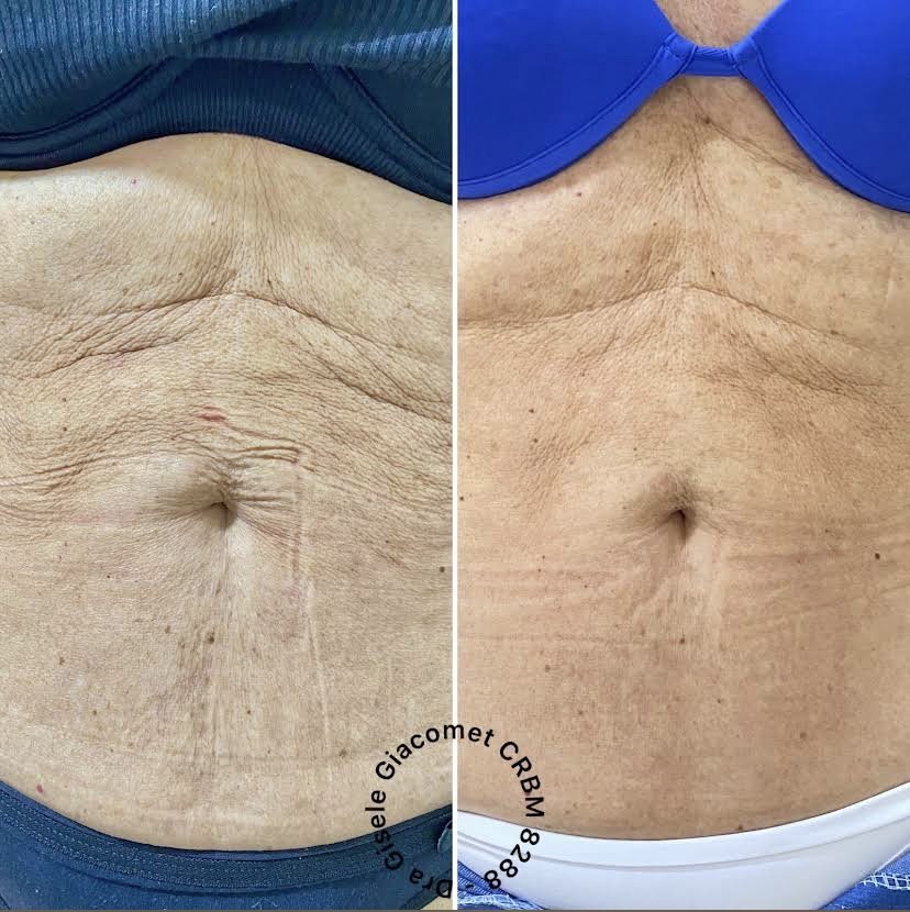 Antes e depois — bioestimulador de colágeno