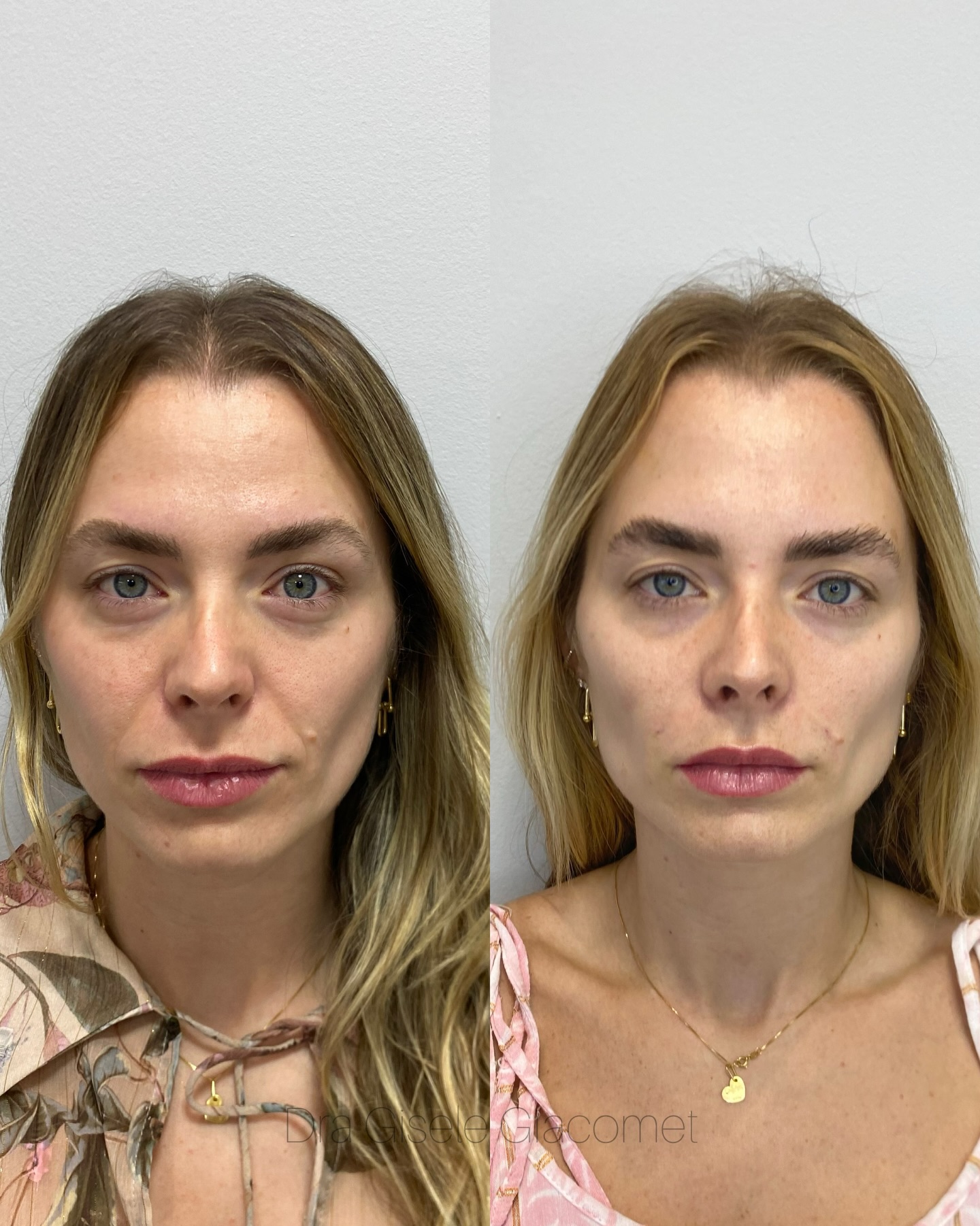 Antes e depois — harmonização facial