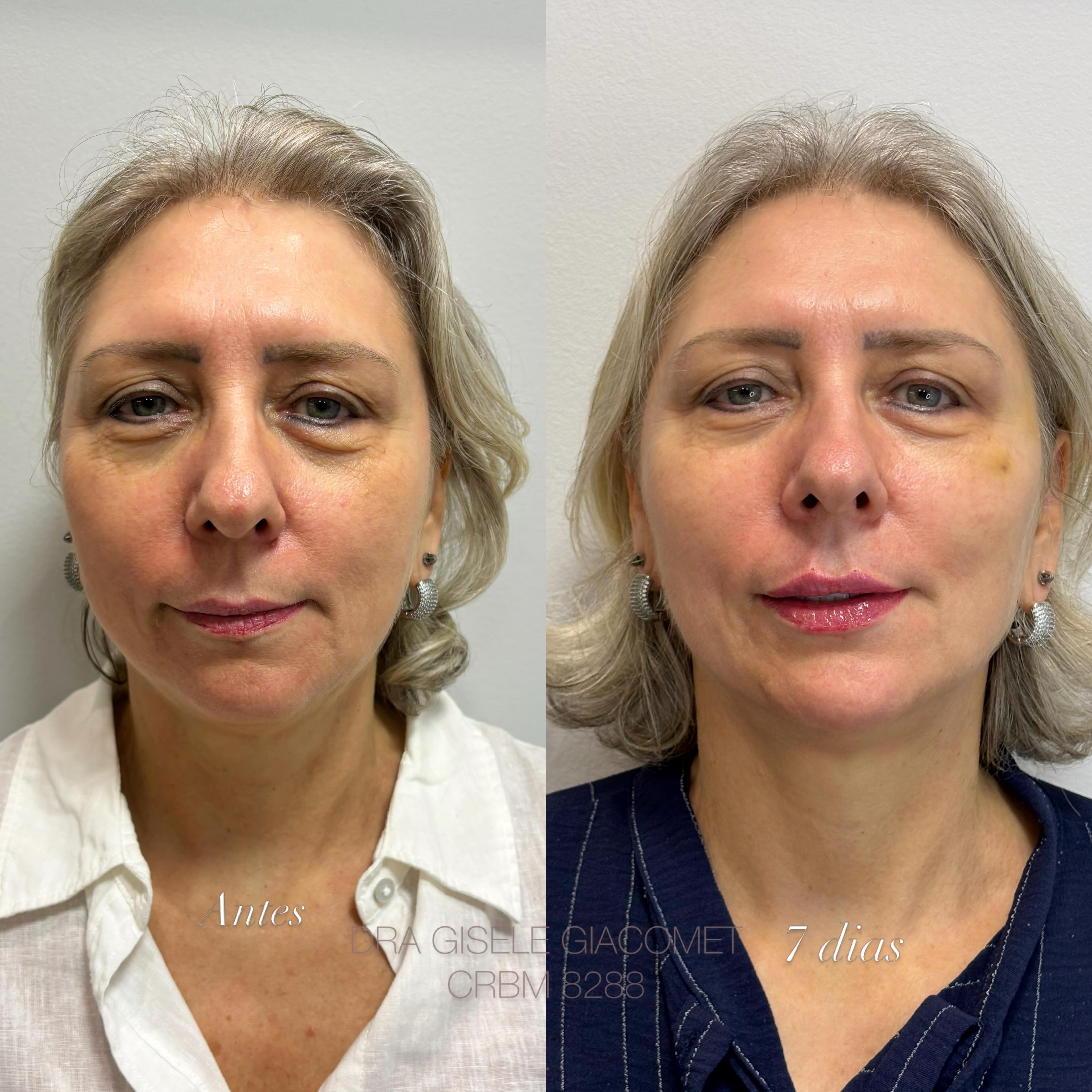 Antes e depois — harmonização facial