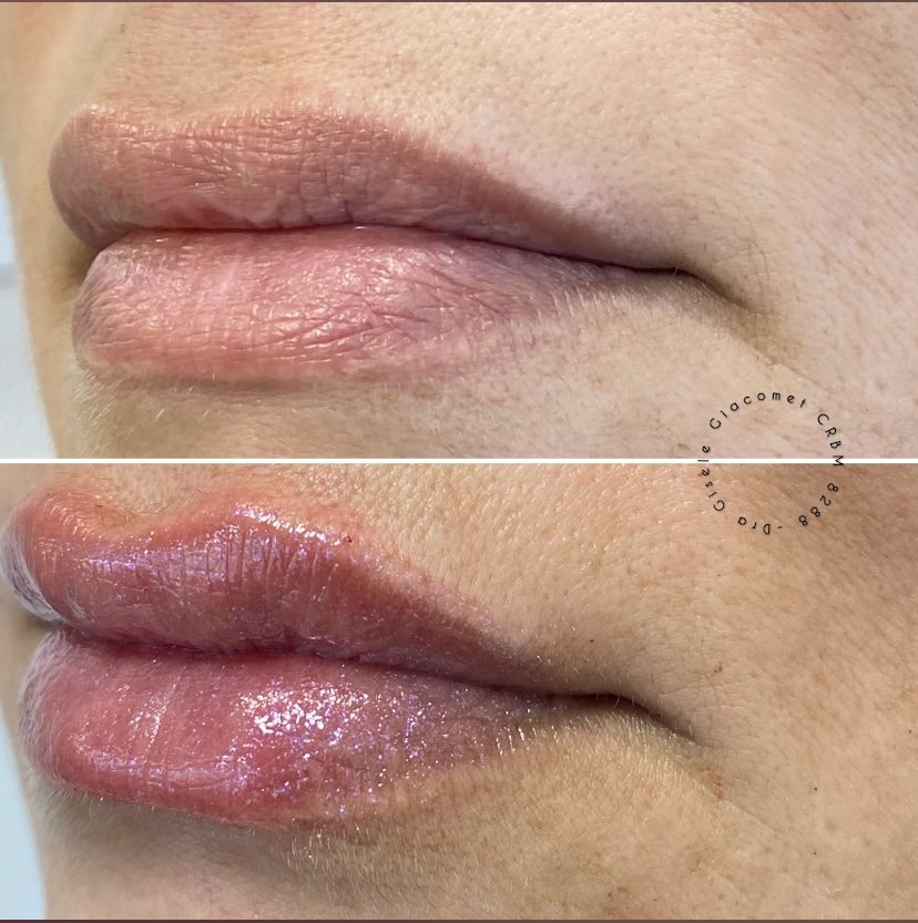 Antes e depois — preenchimento labial