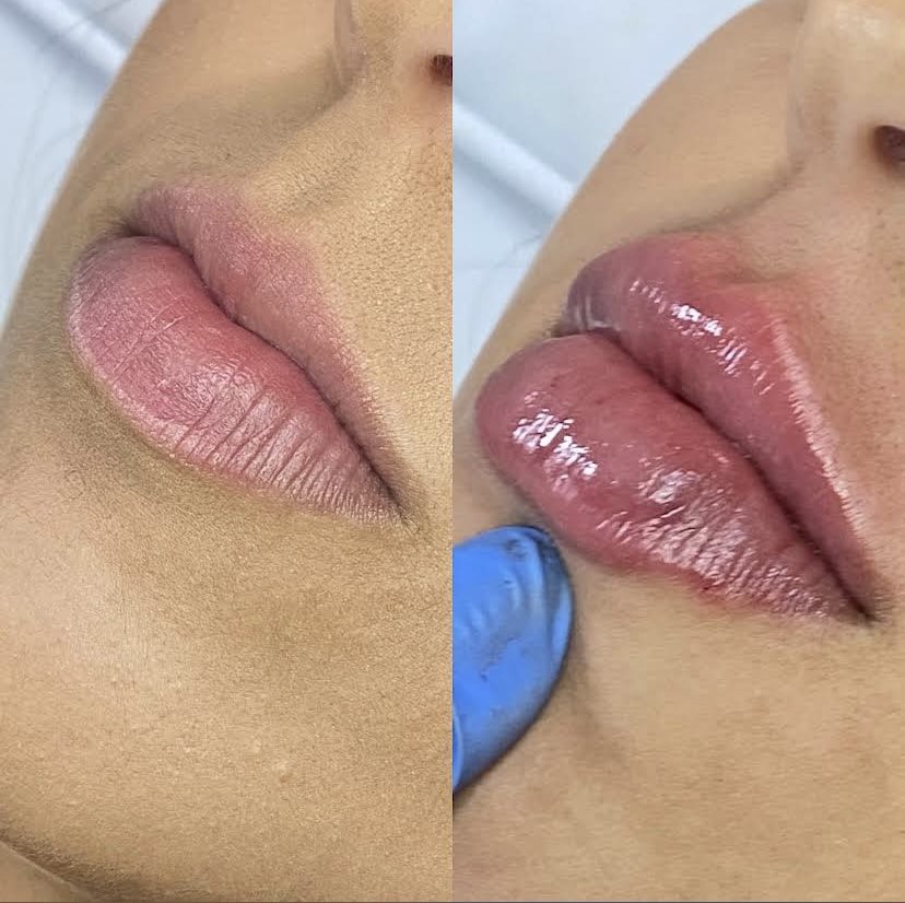 Antes e depois — preenchimento labial