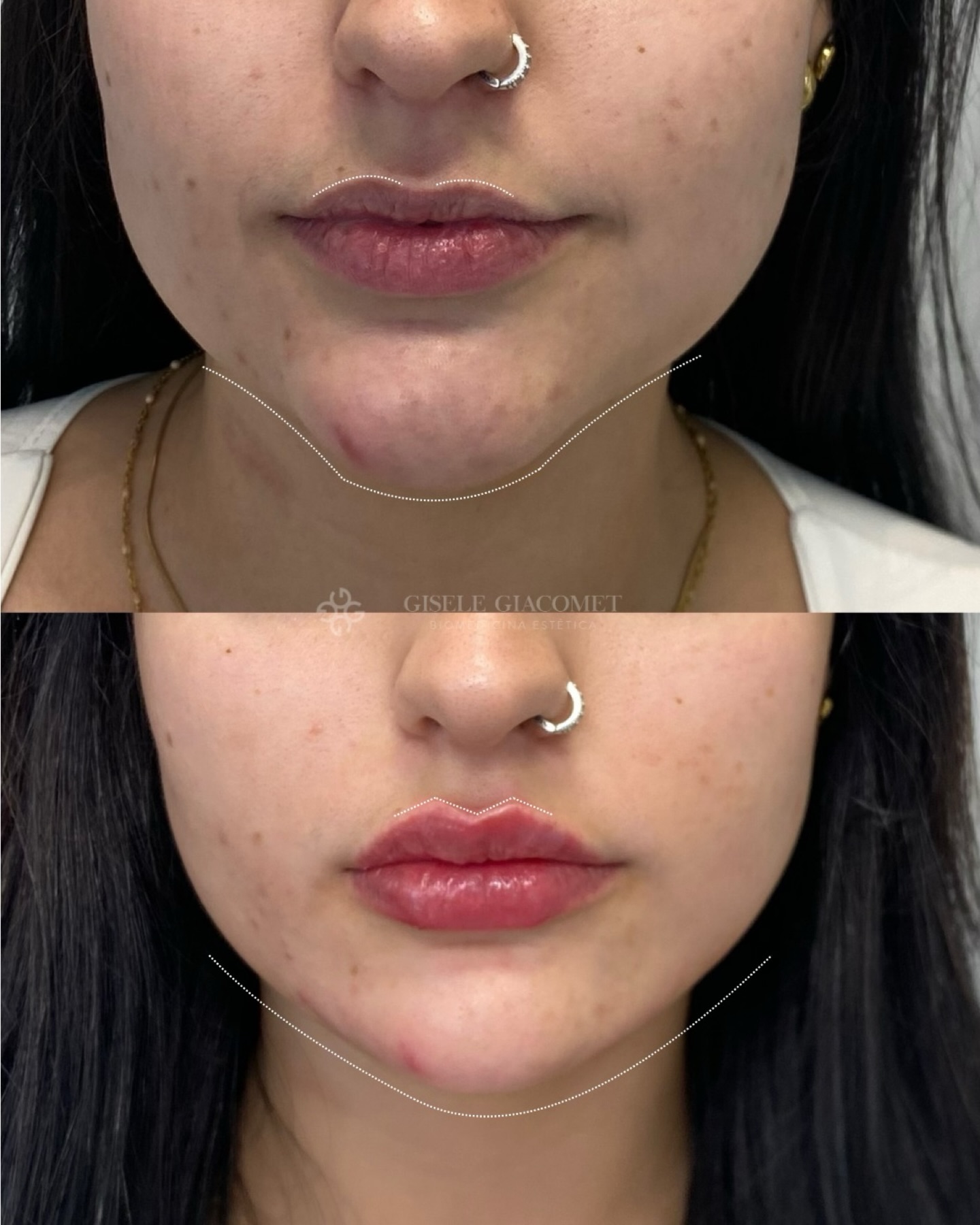 Antes e depois — preenchimento labial