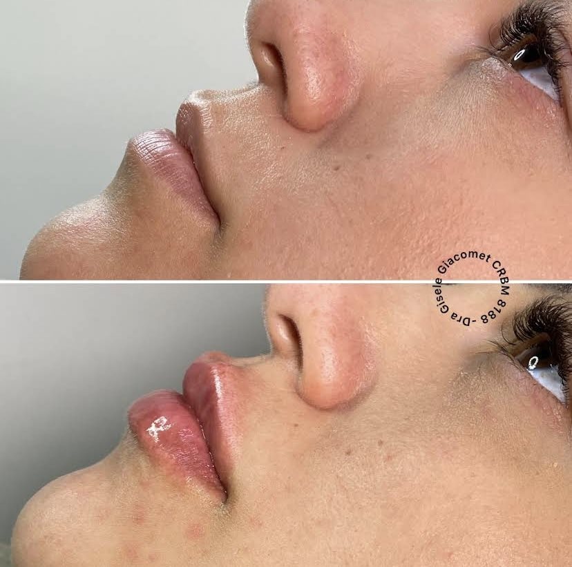 Antes e depois — harmonização de perfil
