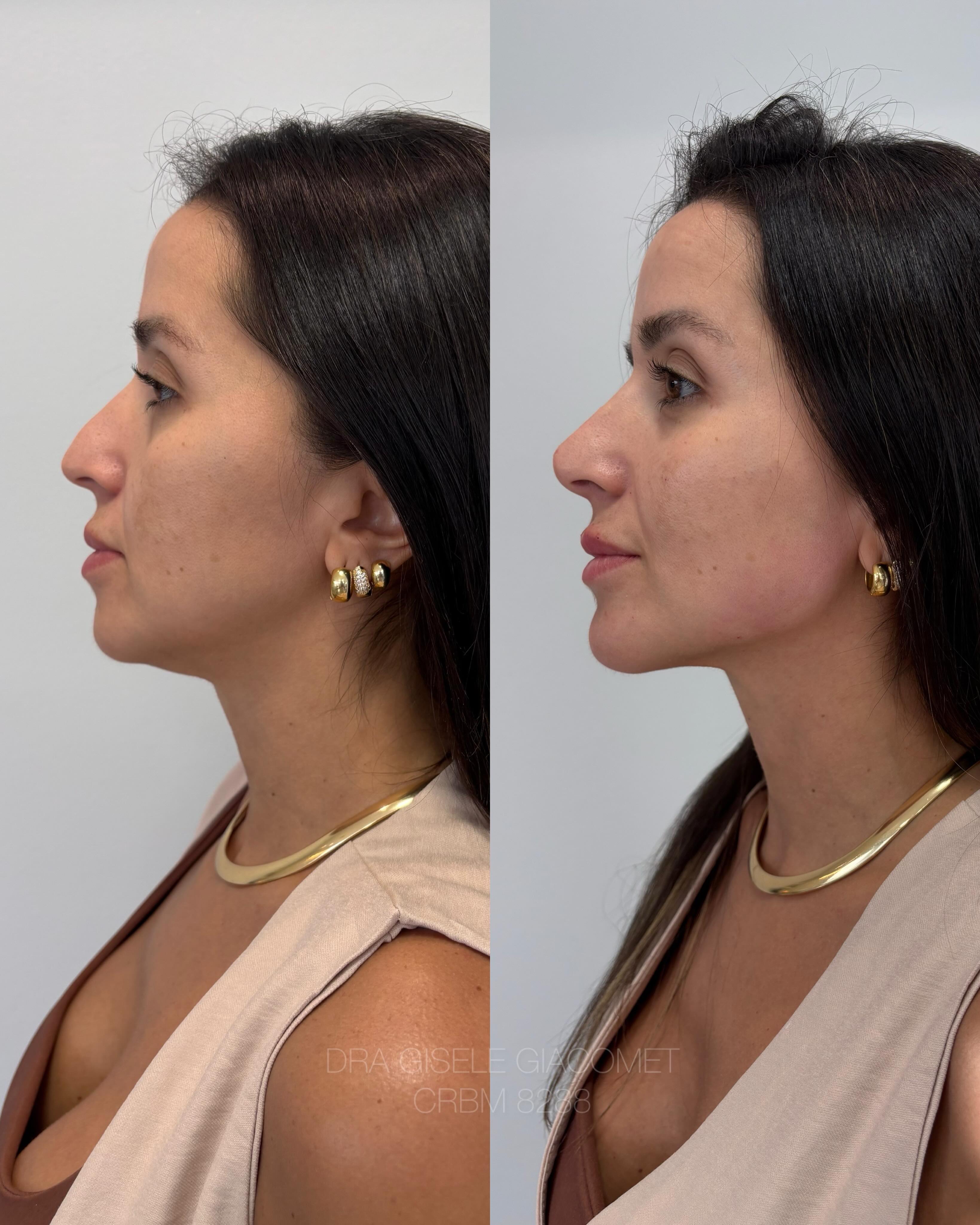 Antes e depois — harmonização de perfil