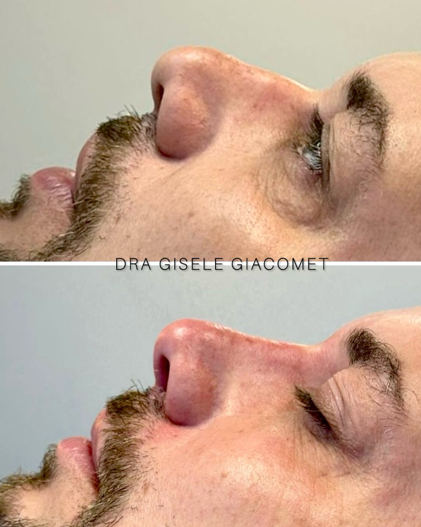 Antes e depois — rinomodelação