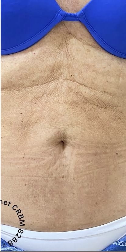 Bioestimulador de Colágeno — resultado