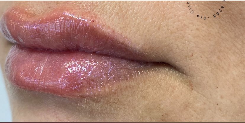 Preenchimento Labial — resultado